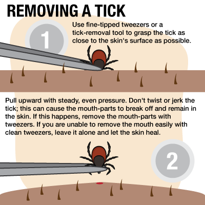 How to Remove a Tick: Use fine-tipped tweezers or a tick-removal tool to grasp the tick as close to the skin's surface as possible. Pull upward with steady, even pressure. Don't twist or jerk the tick, this can cause the mouth-parts to break off and remain in the skin. If this happens, remove the mouth-parts with tweezers. If you are unabe to remove the mouth easily with clean tweezers, leave it alone and let the skin heal.