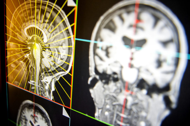 What Do the Brains of Children Tell Us about Their Mental Health as Teens?