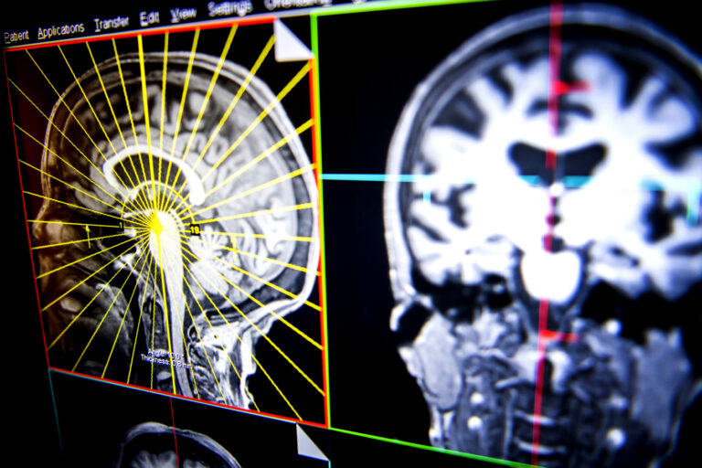 Landmark study into the genetic disorder offers clues into links between metabolism and mental health