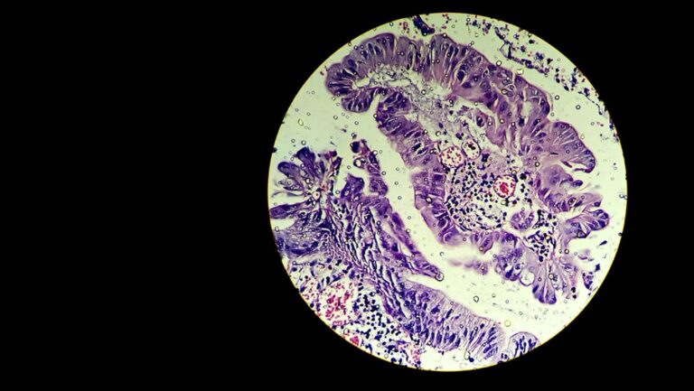 Northeastern researchers identify proteins receptive to treating ovarian cancer